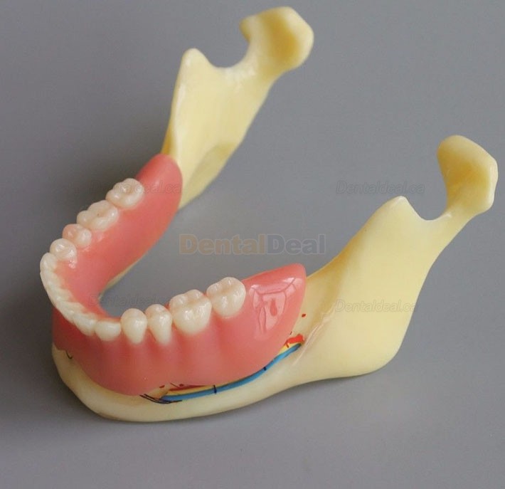 Dental Implant Overdenture Model for Study Training Demonstration #2014 02