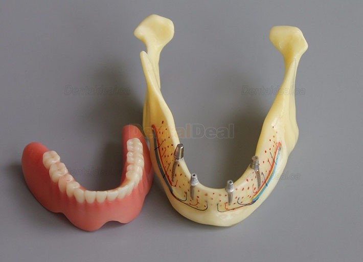 Dental Implant Overdenture Model for Study Training Demonstration #2014 02