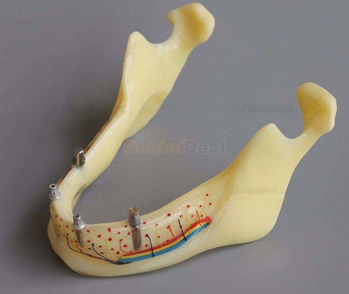 Dental Implant Overdenture Model for Study Training Demonstration #2014 02
