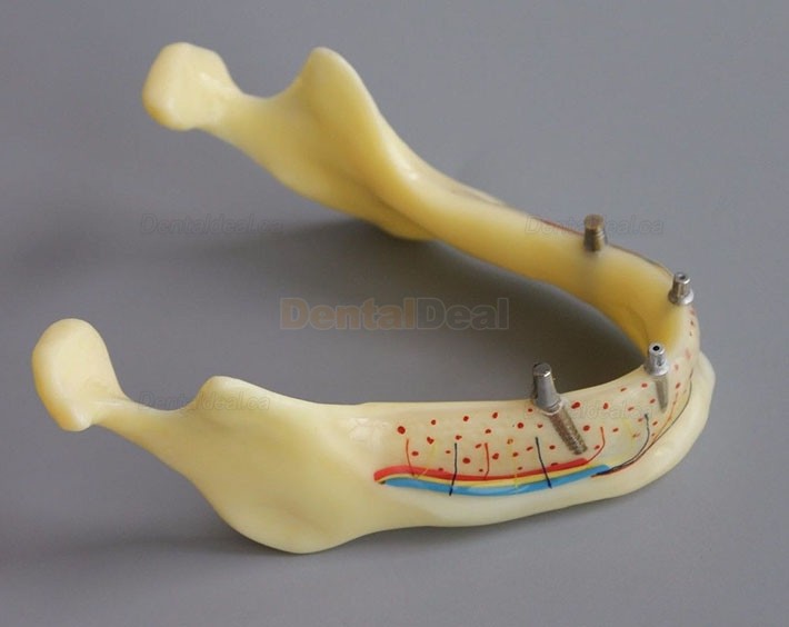Dental Implant Overdenture Model for Study Training Demonstration #2014 02