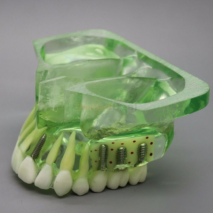 Dental Model Upper Jaw Implant Study Training Demo Model with Sinus 2015 01