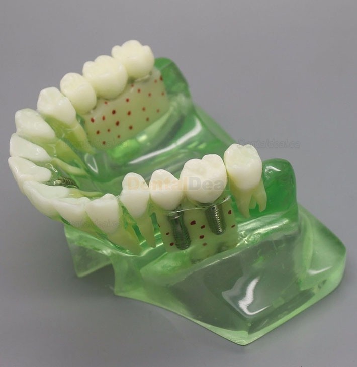 Dental Model Upper Jaw Implant Study Training Demo Model with Sinus 2015 01