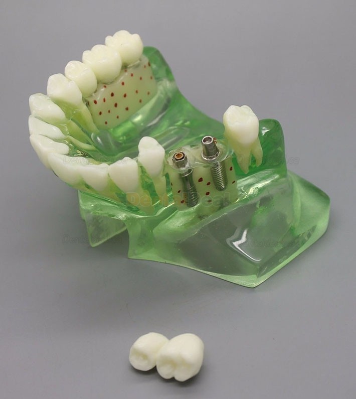 Dental Model Upper Jaw Implant Study Training Demo Model with Sinus 2015 01