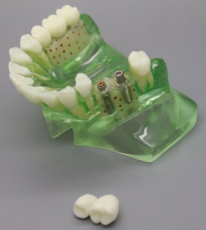 Dental Model Upper Jaw Implant Study Training Demo Model with Sinus 2015 01