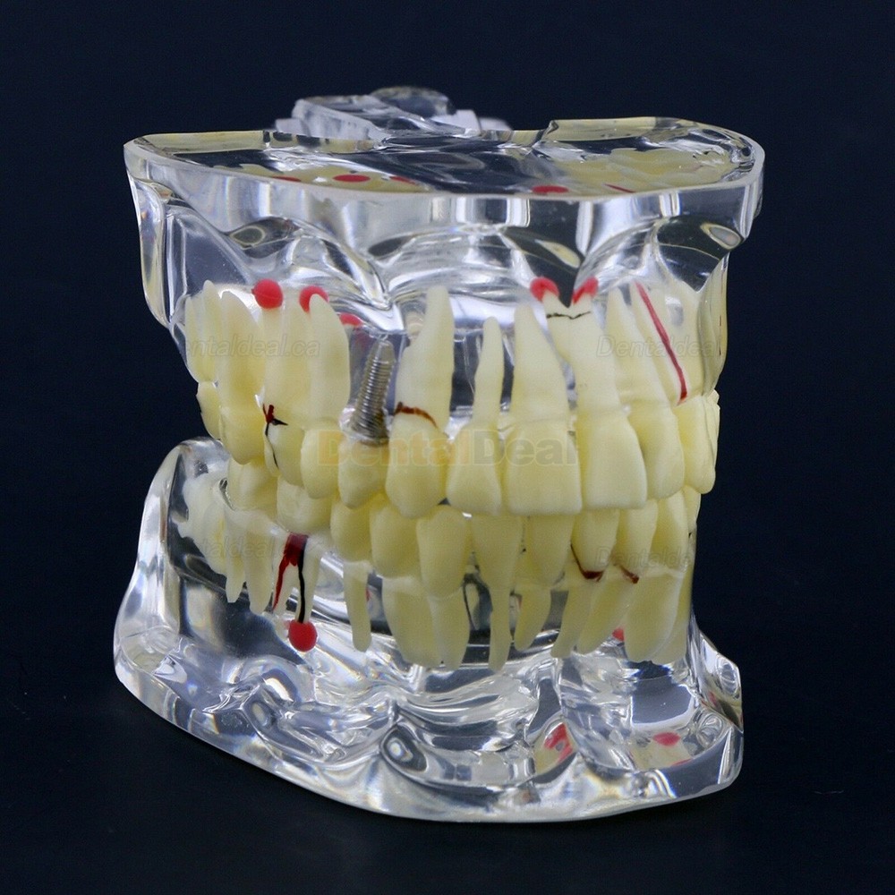 Dental Study Model Adult Pathology Typodont Teeth Teaching Model #4001