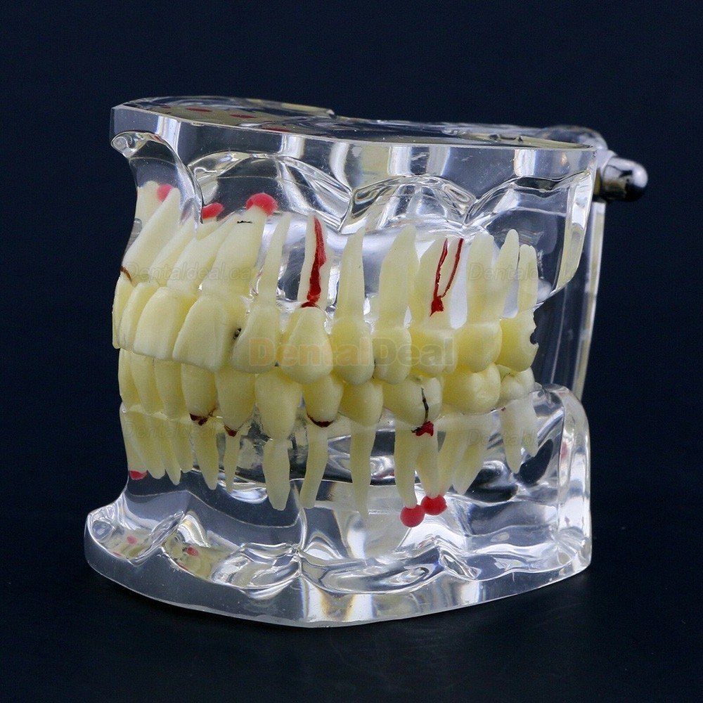 Dental Study Model Adult Pathology Typodont Teeth Teaching Model #4001