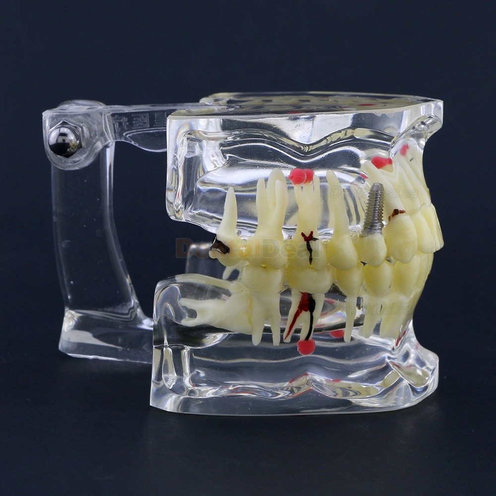 Dental Study Model Adult Pathology Typodont Teeth Teaching Model #4001