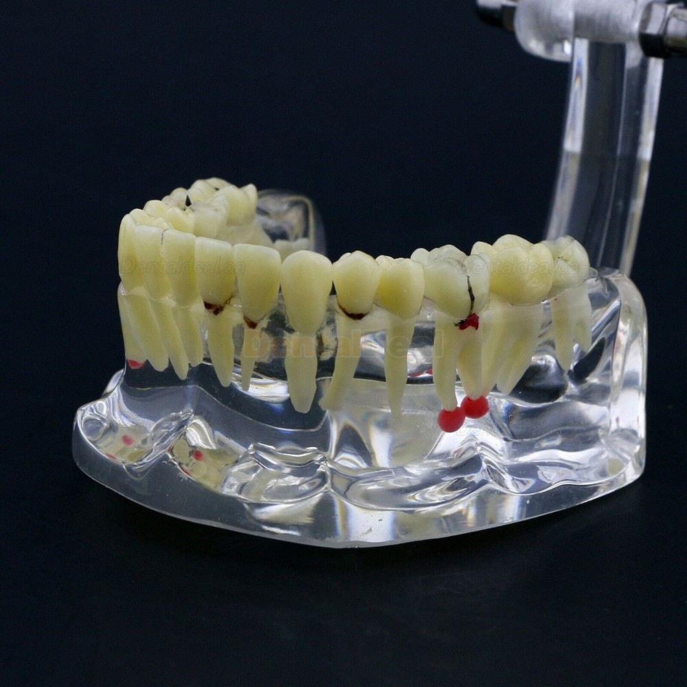 Dental Study Model Adult Pathology Typodont Teeth Teaching Model #4001