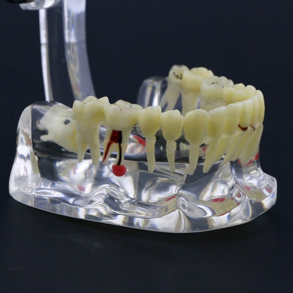 Dental Study Model Adult Pathology Typodont Teeth Teaching Model #4001