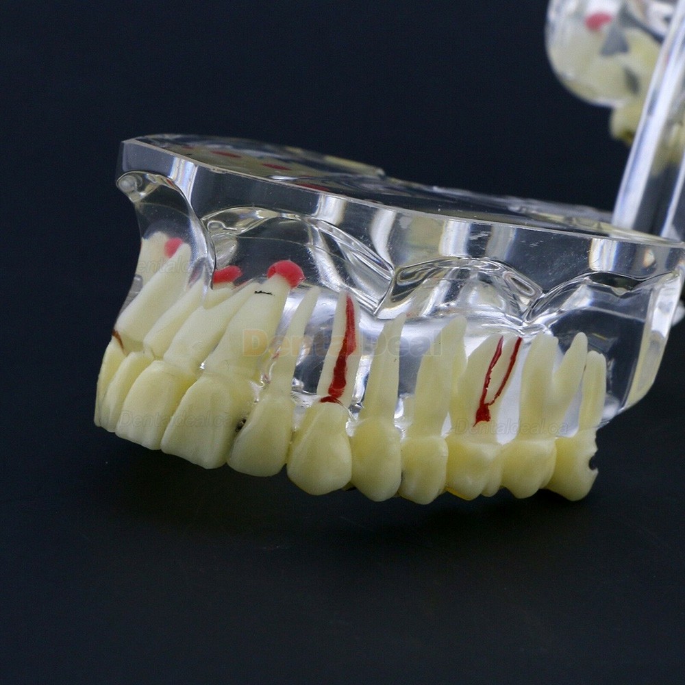 Dental Study Model Adult Pathology Typodont Teeth Teaching Model #4001