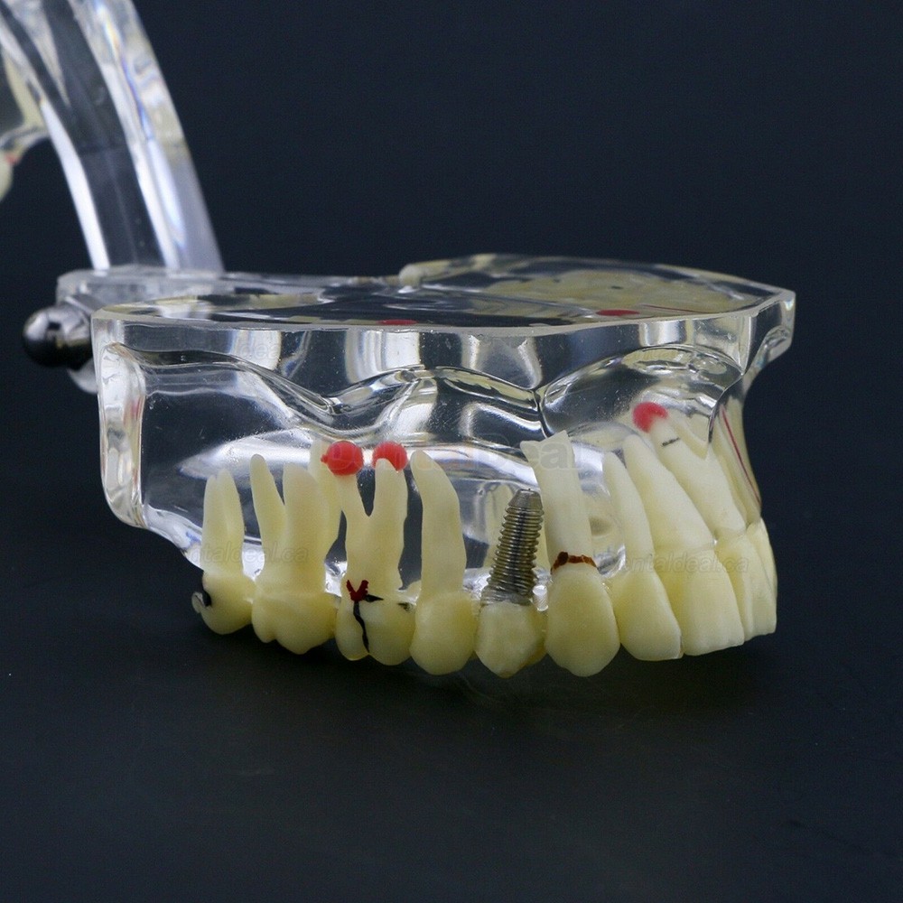 Dental Study Model Adult Pathology Typodont Teeth Teaching Model #4001
