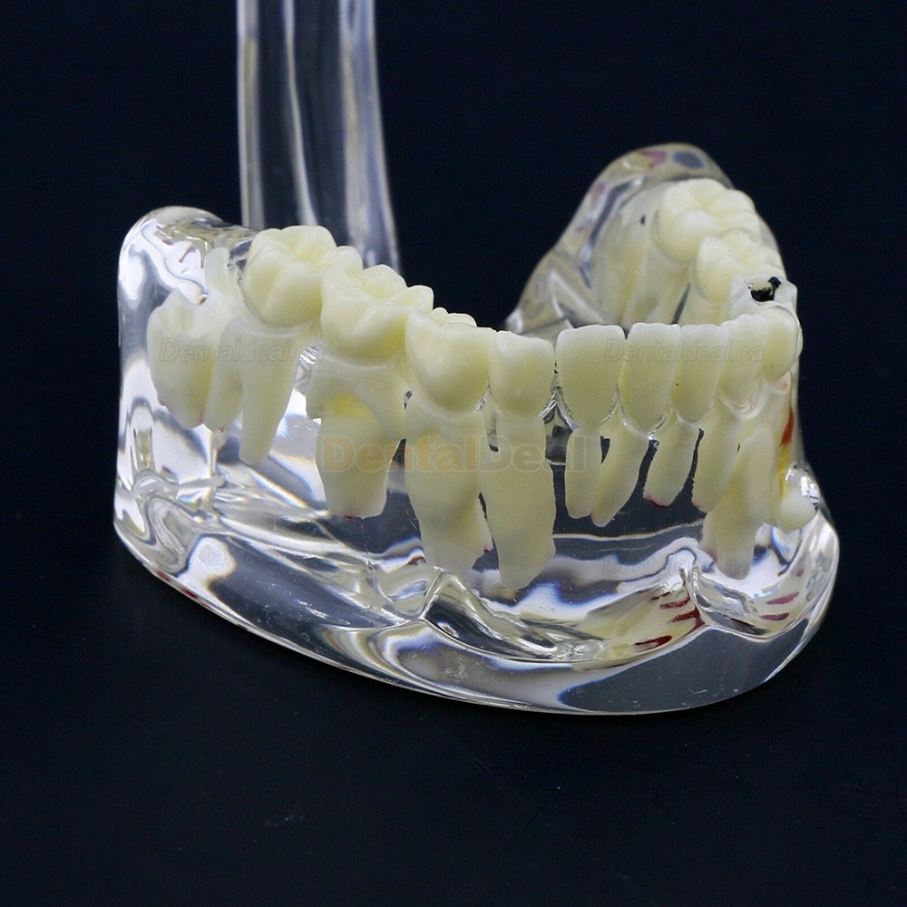Dental Children Pediatric Pathology Demonstration Education Study Teeth Model 4002