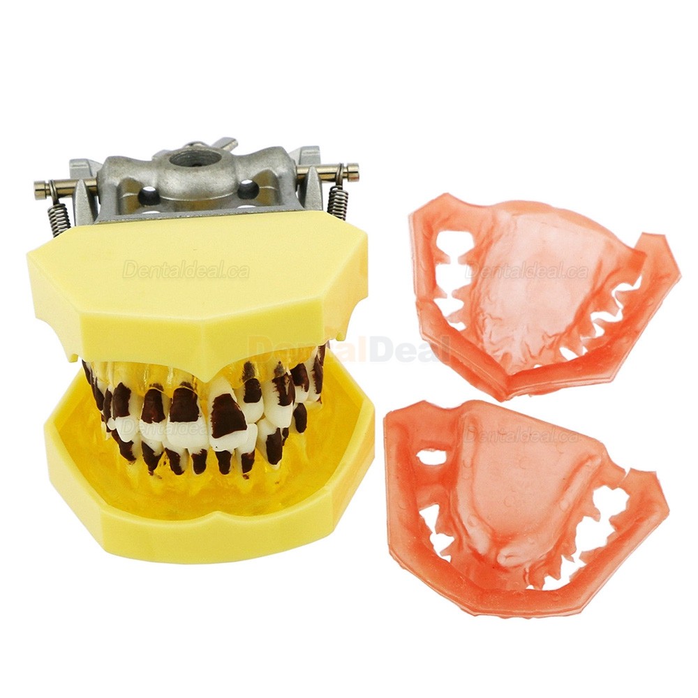 Teeth Periodontal Model Demonstration Training Study Model Inflamed Gingivae Calculs 4003