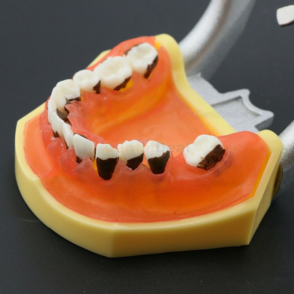 Teeth Periodontal Model Demonstration Training Study Model Inflamed Gingivae Calculs 4003