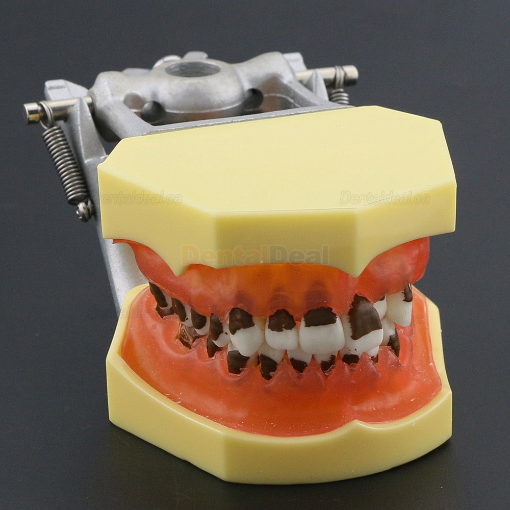 Teeth Periodontal Model Demonstration Training Study Model Inflamed Gingivae Calculs 4003