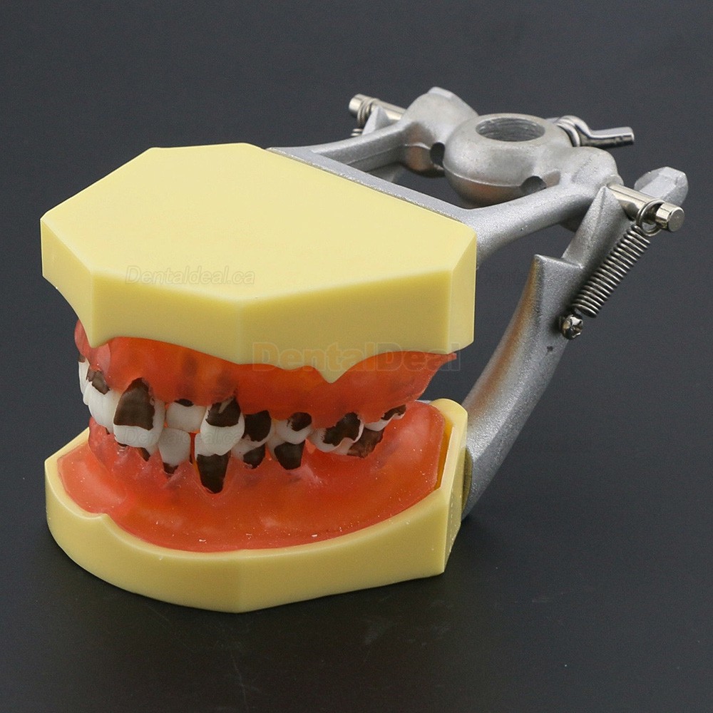 Teeth Periodontal Model Demonstration Training Study Model Inflamed Gingivae Calculs 4003