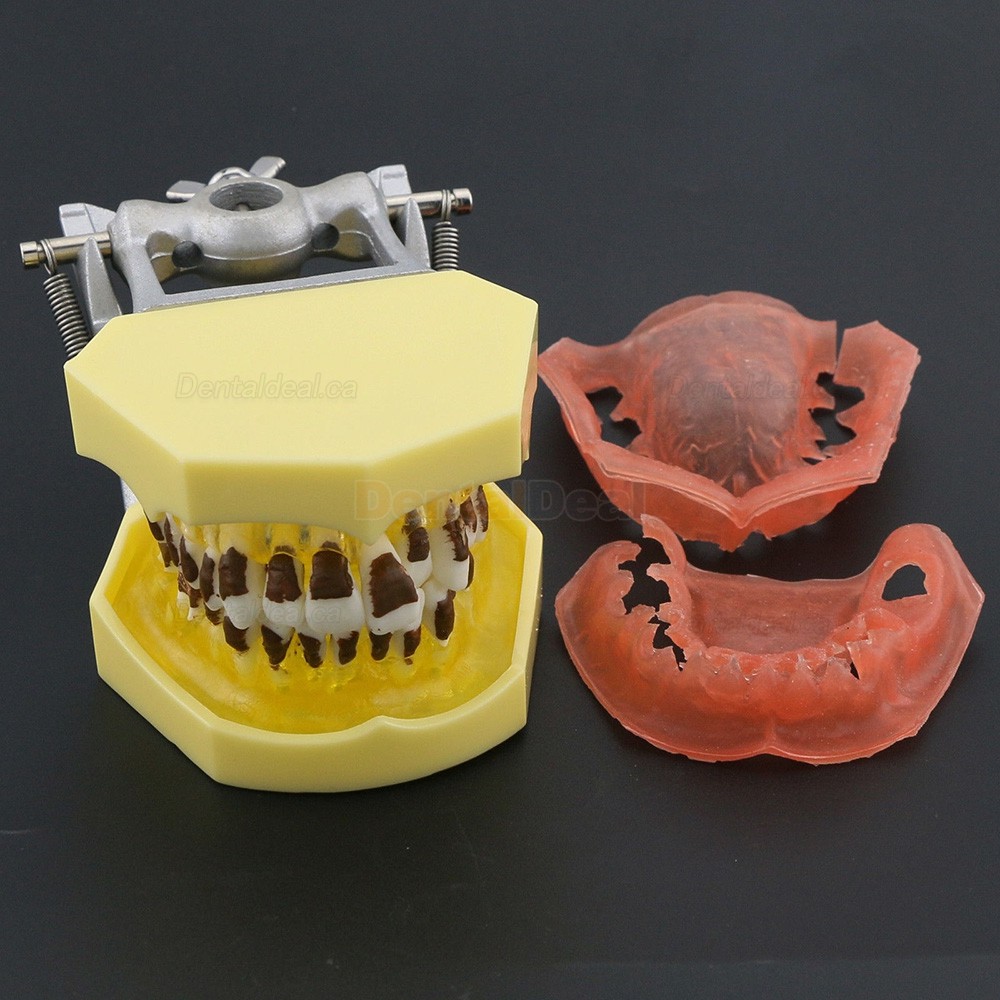 Teeth Periodontal Model Demonstration Training Study Model Inflamed Gingivae Calculs 4003