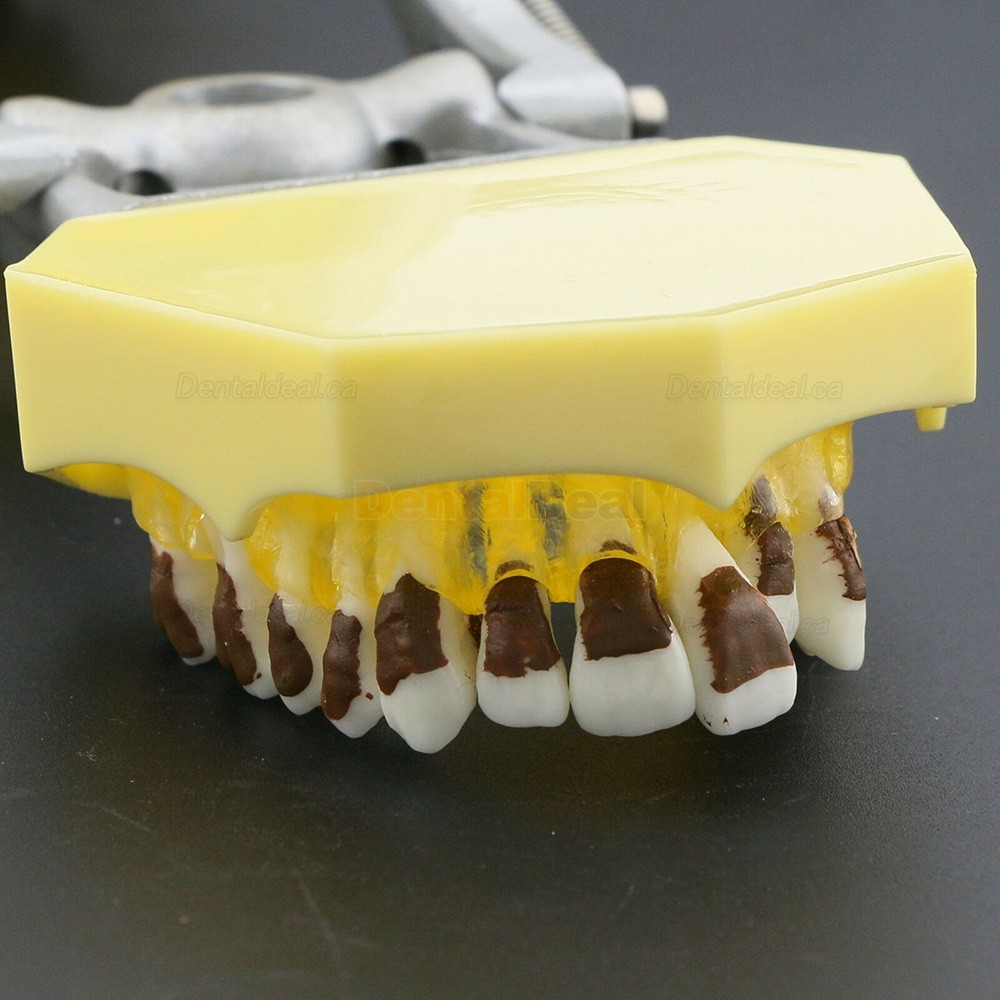Teeth Periodontal Model Demonstration Training Study Model Inflamed Gingivae Calculs 4003