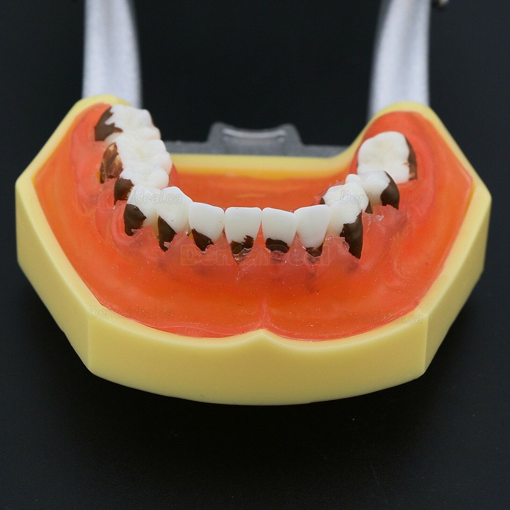 Teeth Periodontal Model Demonstration Training Study Model Inflamed Gingivae Calculs 4003