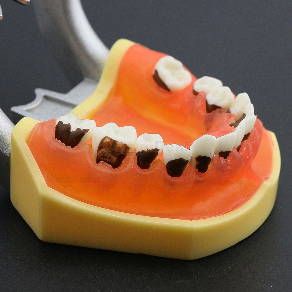 Teeth Periodontal Model Demonstration Training Study Model Inflamed Gingivae Calculs 4003