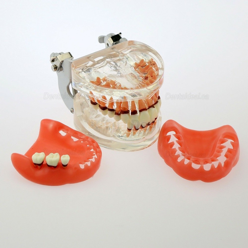 Dental Model Adult Periodontal Disease Study Demo Training Teeth Model 4017