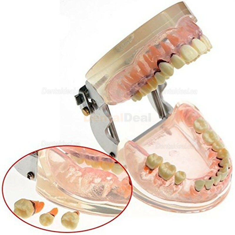 Dental Model Adult Periodontal Disease Study Demo Training Teeth Model 4017