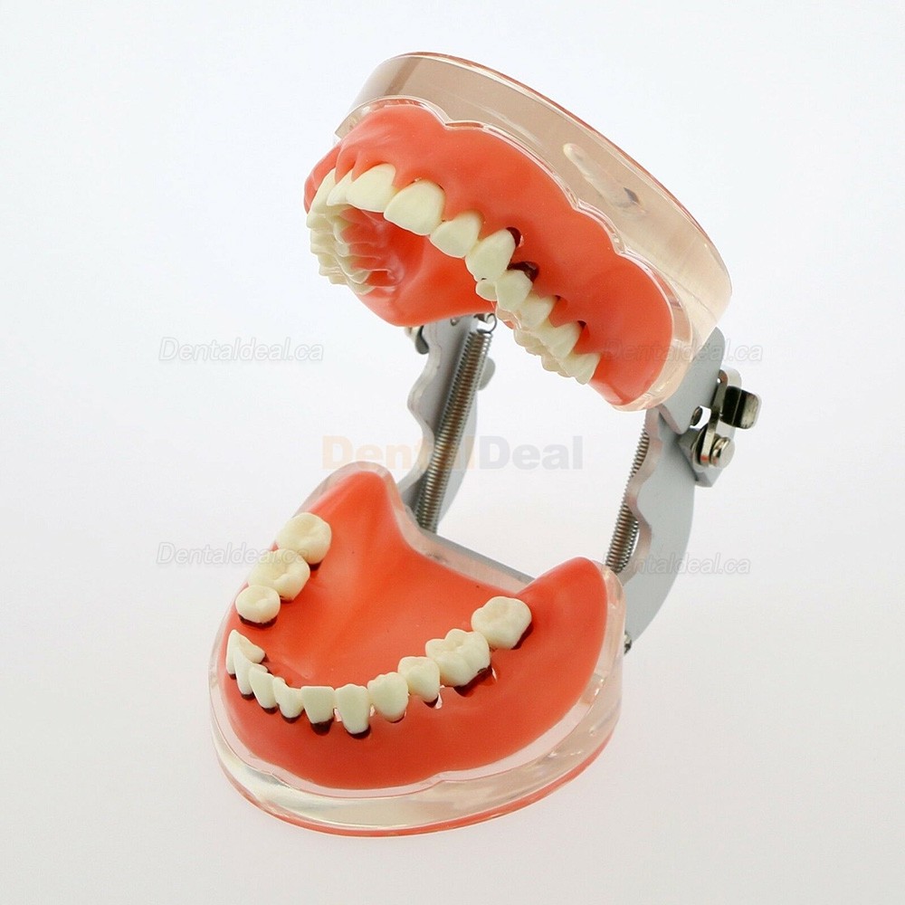 Dental Model Adult Periodontal Disease Study Demo Training Teeth Model 4017