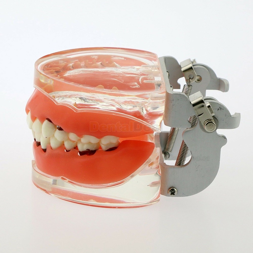 Dental Model Adult Periodontal Disease Study Demo Training Teeth Model 4017