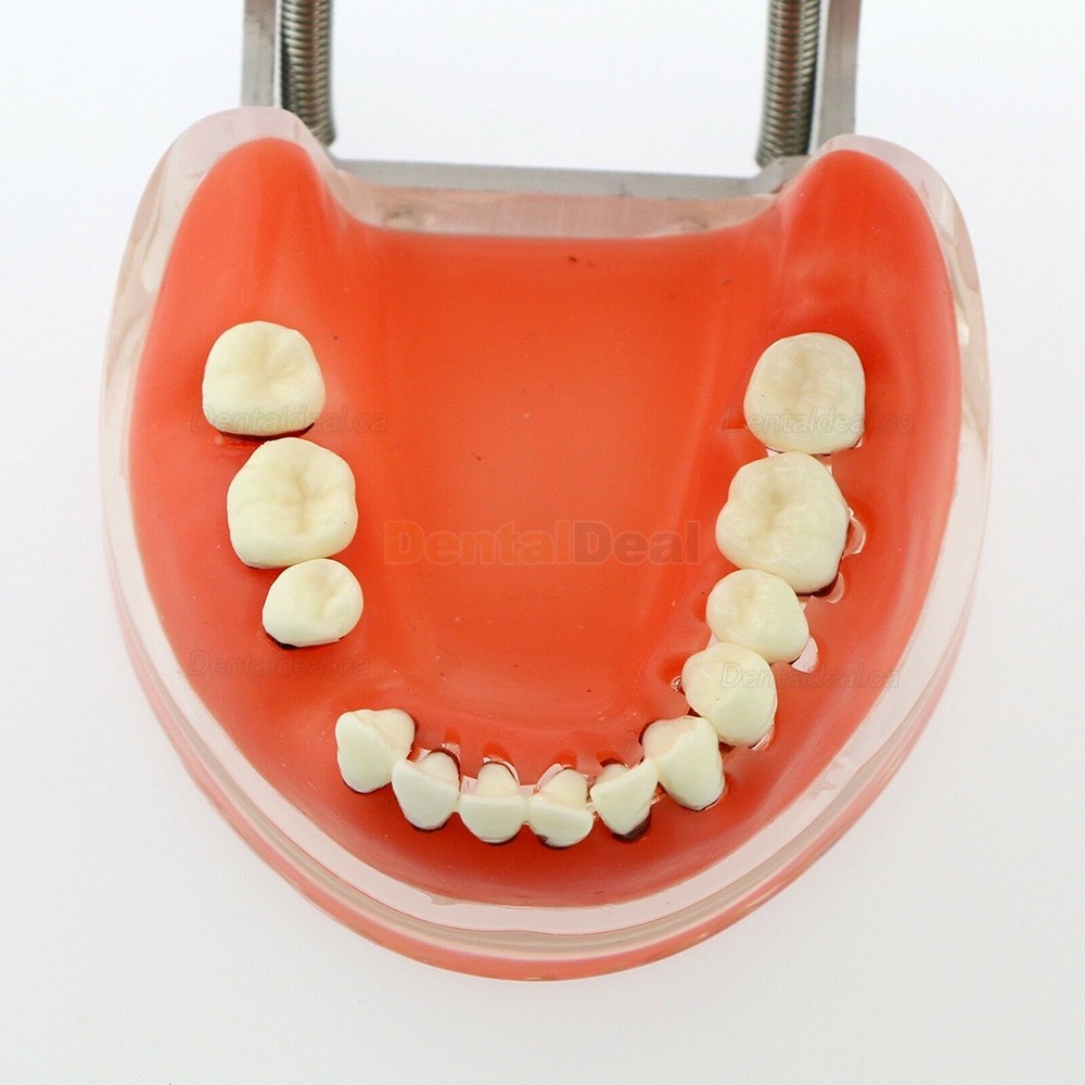 Dental Model Adult Periodontal Disease Study Demo Training Teeth Model 4017