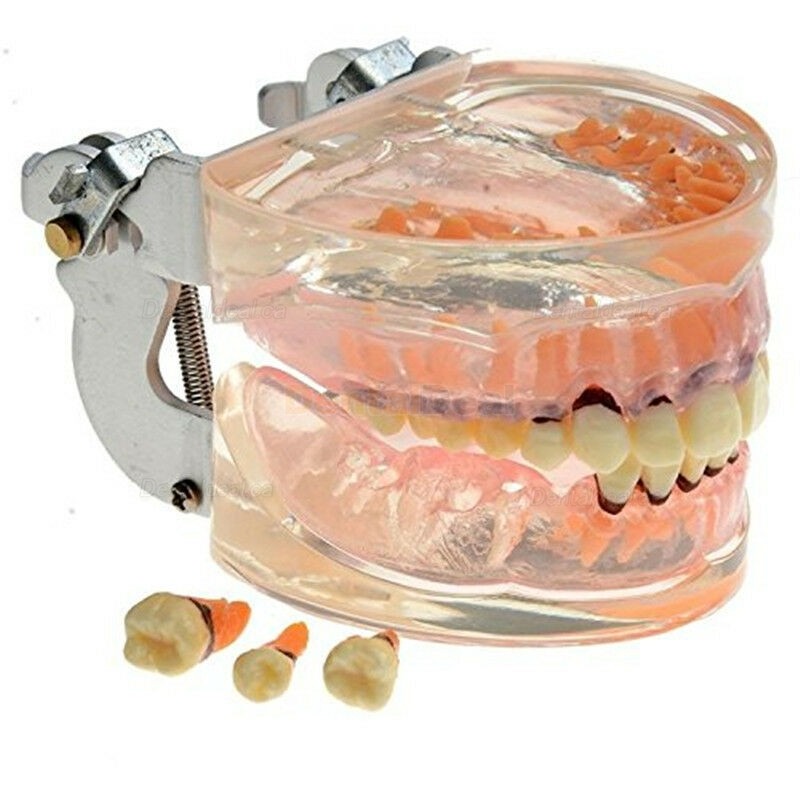 Dental Model Adult Periodontal Disease Study Demo Training Teeth Model 4017