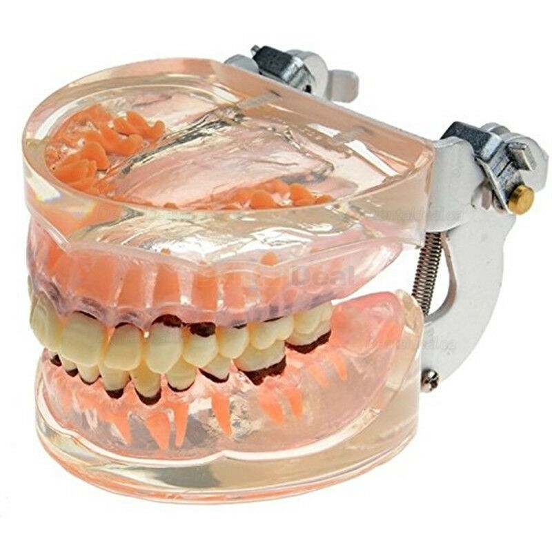 Dental Model Adult Periodontal Disease Study Demo Training Teeth Model 4017