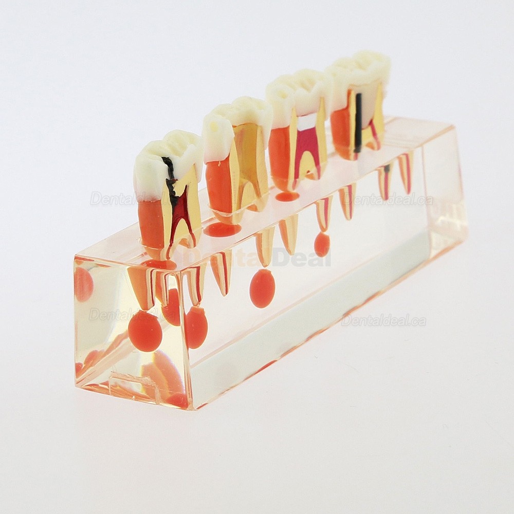 Dental Teeth Anatomical Model 4-Stage Endodontic Treatment Study Traning Model 4018 01