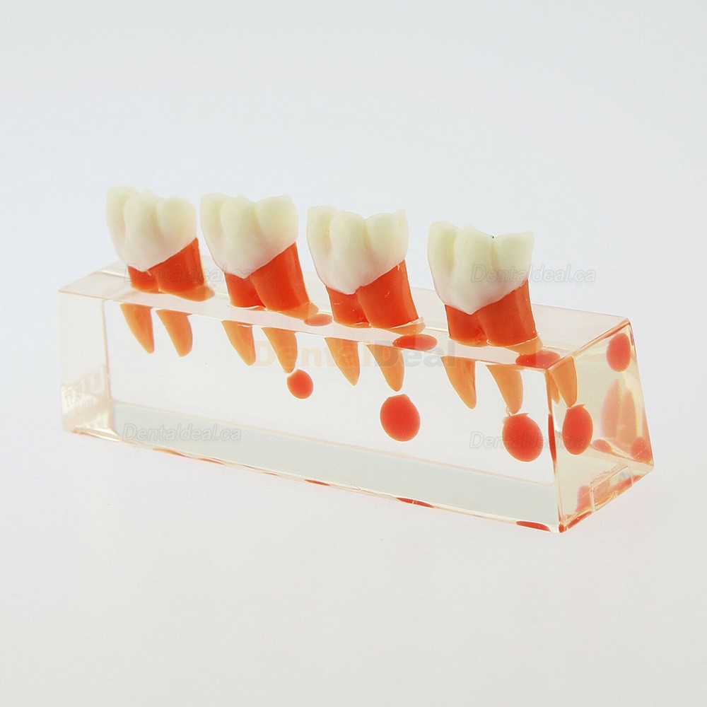 Dental Teeth Anatomical Model 4-Stage Endodontic Treatment Study Traning Model 4018 01