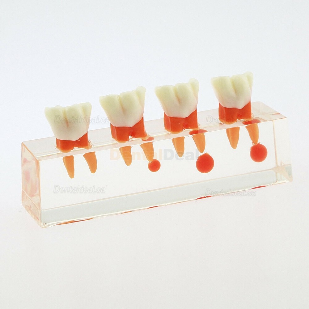 Dental Teeth Anatomical Model 4-Stage Endodontic Treatment Study Traning Model 4018 01