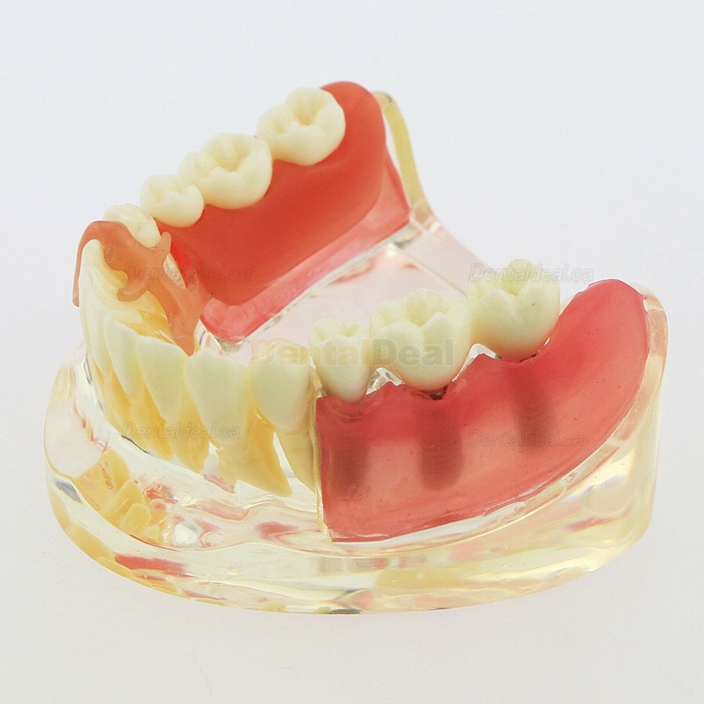 Dental Teeth Implant Model with Removable Bridge Demo Model 6006