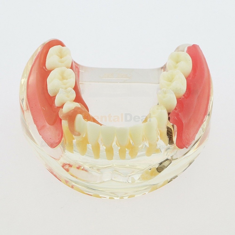 Dental Teeth Implant Model with Removable Bridge Demo Model 6006