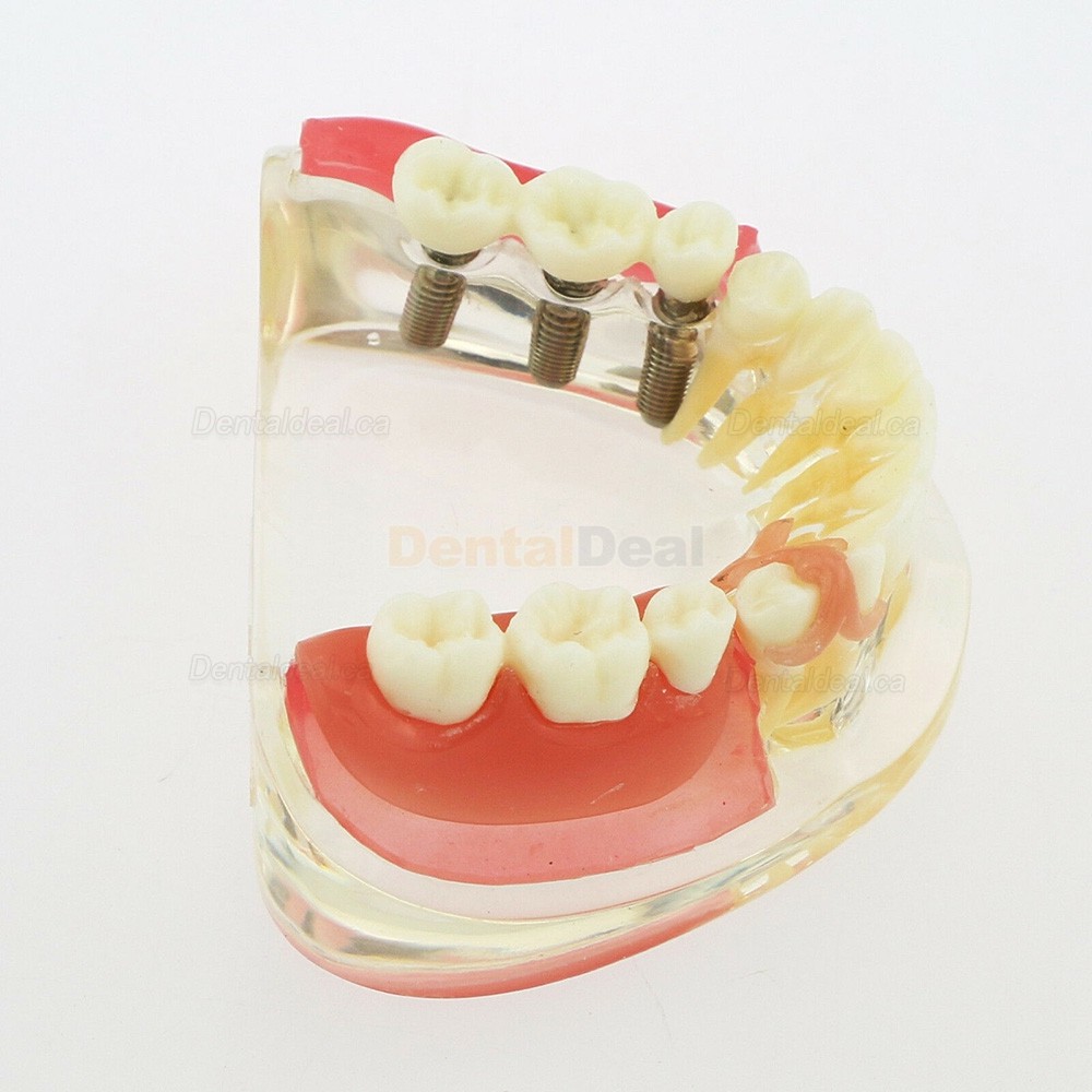 Dental Teeth Implant Model with Removable Bridge Demo Model 6006