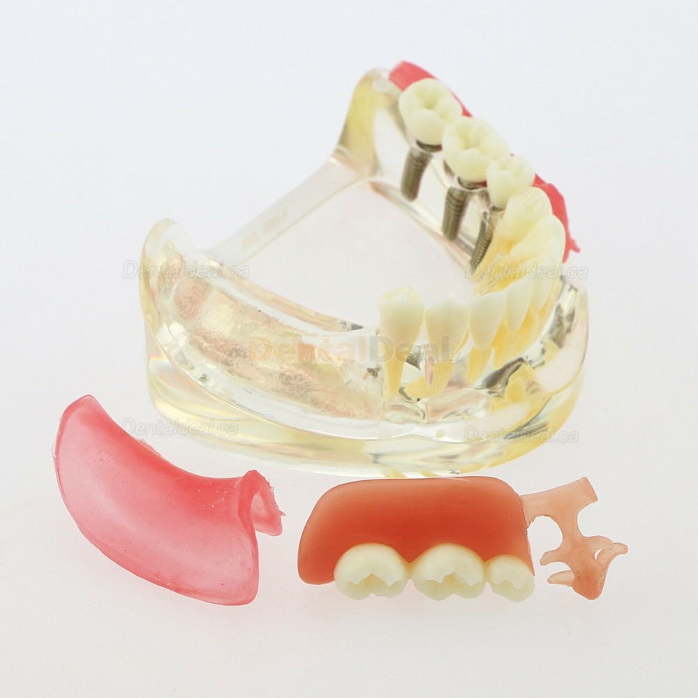 Dental Teeth Implant Model with Removable Bridge Demo Model 6006
