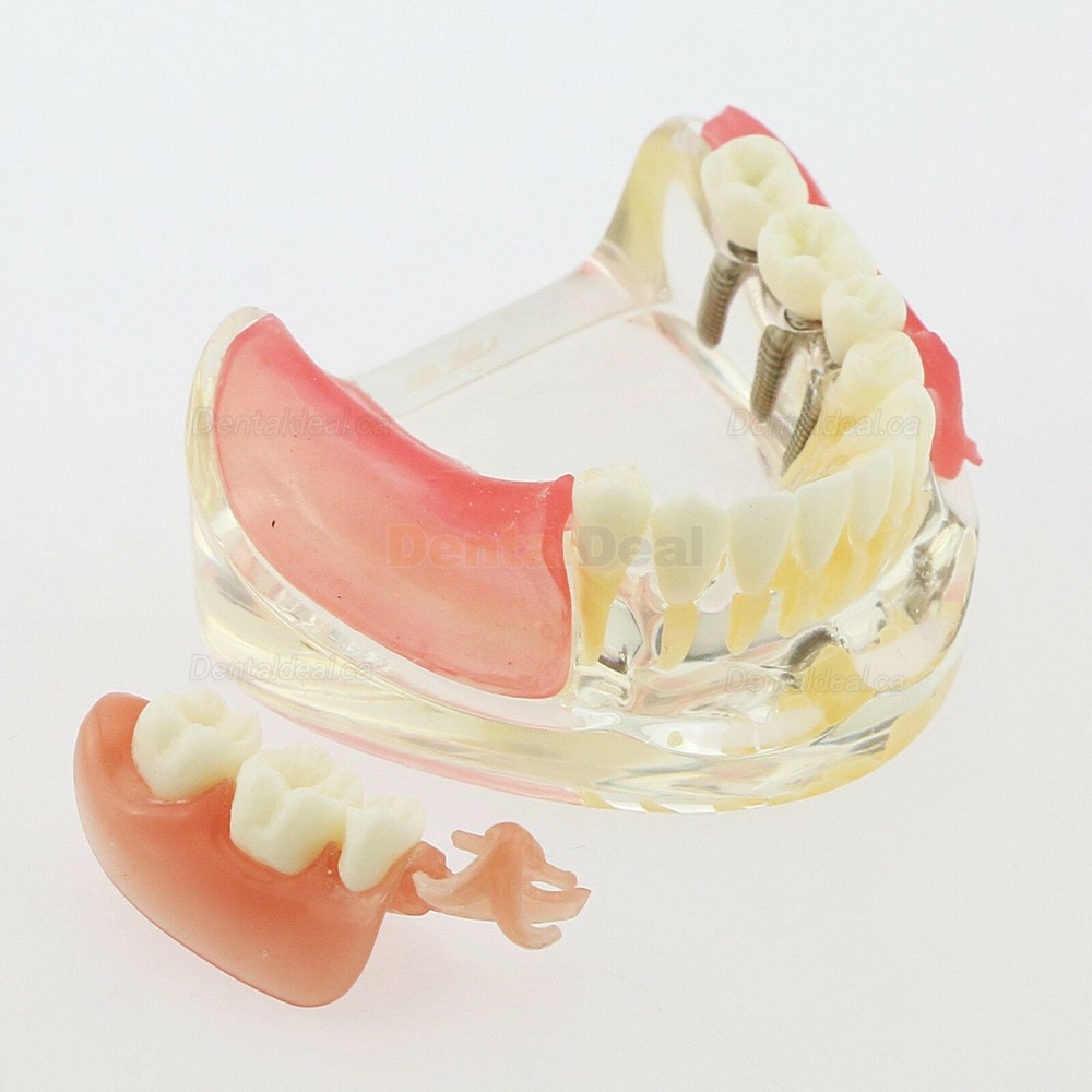 Dental Teeth Implant Model with Removable Bridge Demo Model 6006