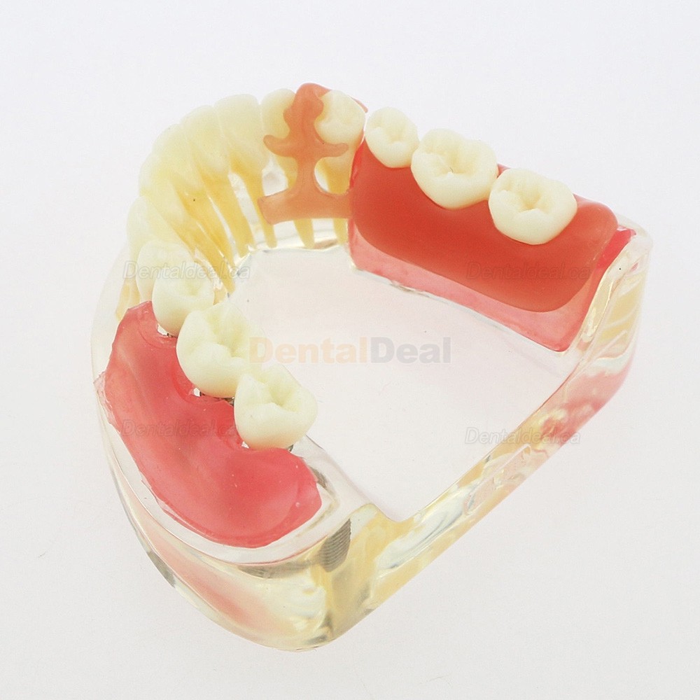 Dental Teeth Implant Model with Removable Bridge Demo Model 6006