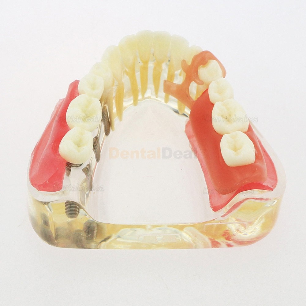 Dental Teeth Implant Model with Removable Bridge Demo Model 6006