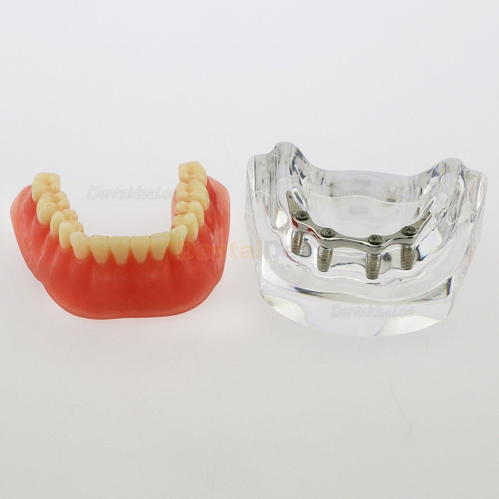 Dental Implant Overdenture Model Lower Jaw with 4 Implants Silver Bar