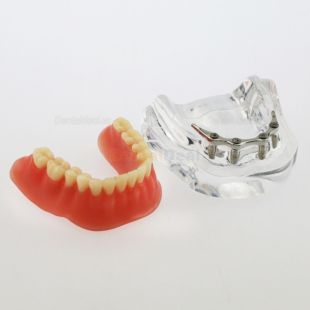 Dental Implant Overdenture Model Lower Jaw with 4 Implants Silver Bar