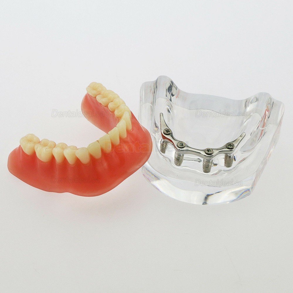 Dental Implant Overdenture Model Lower Jaw with 4 Implants Silver Bar