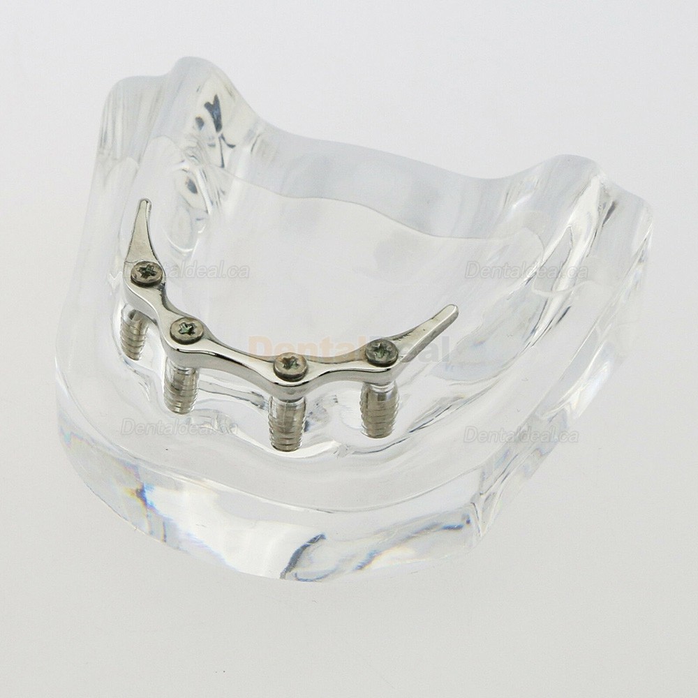 Dental Implant Overdenture Model Lower Jaw with 4 Implants Silver Bar