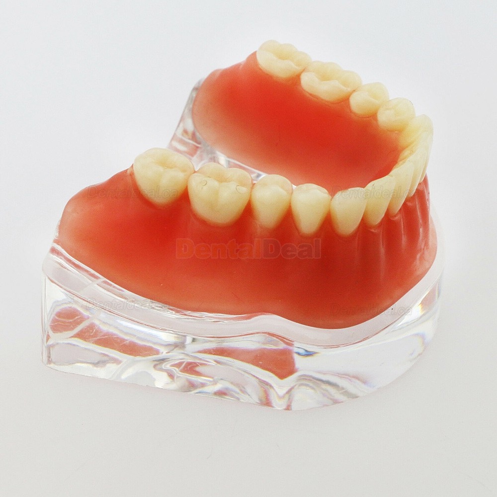 Dental Implant Overdenture Model Lower Jaw with 4 Implants Silver Bar
