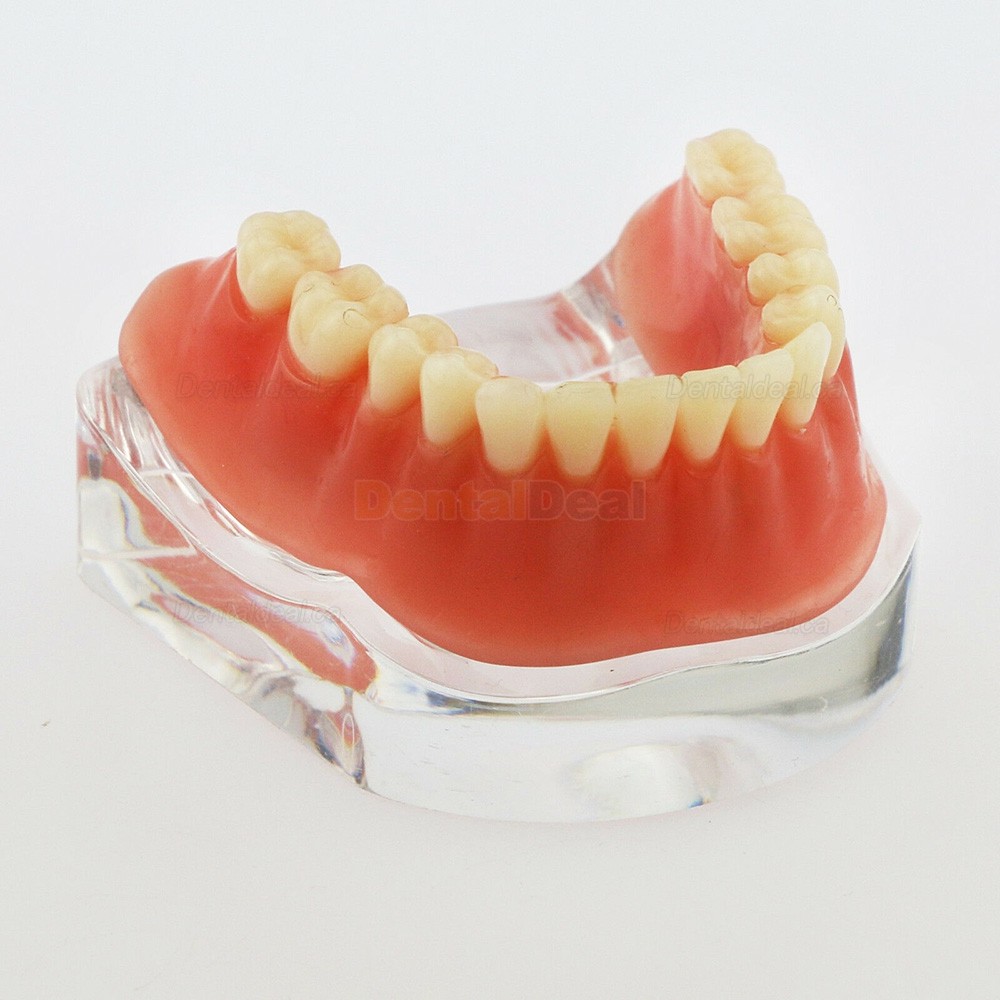 Dental Implant Overdenture Model Lower Jaw with 4 Implants Silver Bar