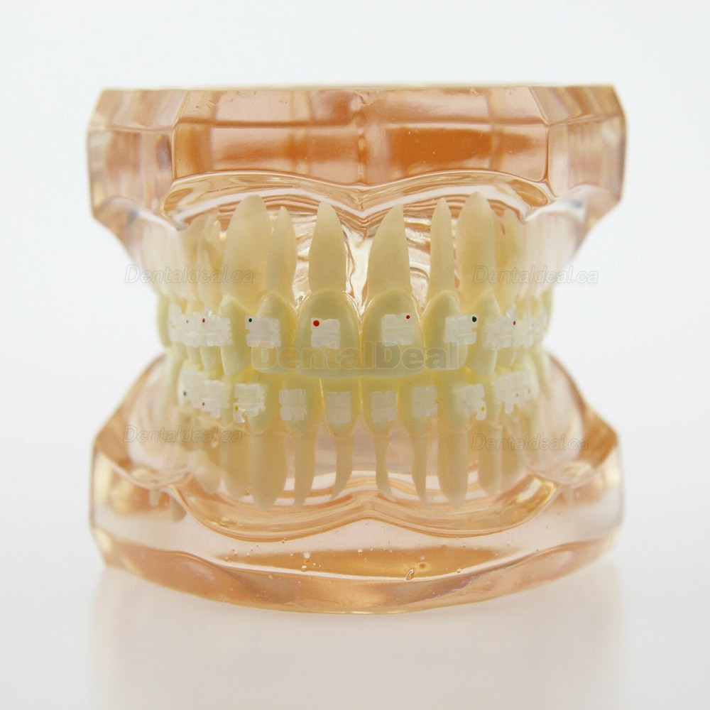 Dental Orthodontic Model with Metal Ceramic Brackets Demo Study Model 3002