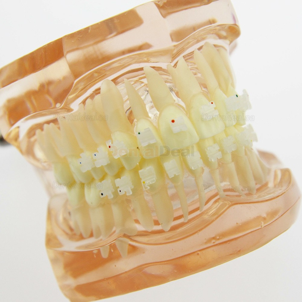 Dental Orthodontic Model with Metal Ceramic Brackets Demo Study Model 3002