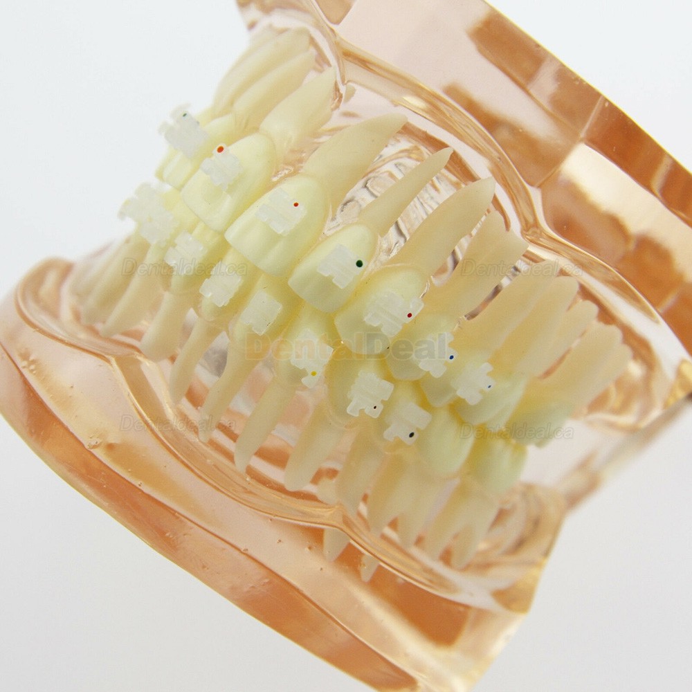 Dental Orthodontic Model with Metal Ceramic Brackets Demo Study Model 3002